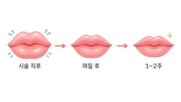 입술필러 시술 직후부터 1~2주까지 붓기가 서서히 가라앉고 최종 모양을 확인하는 흐름을 추상 타임라인으로 표현 - 덕천입술필러 | 미미썸의원 부산덕천점