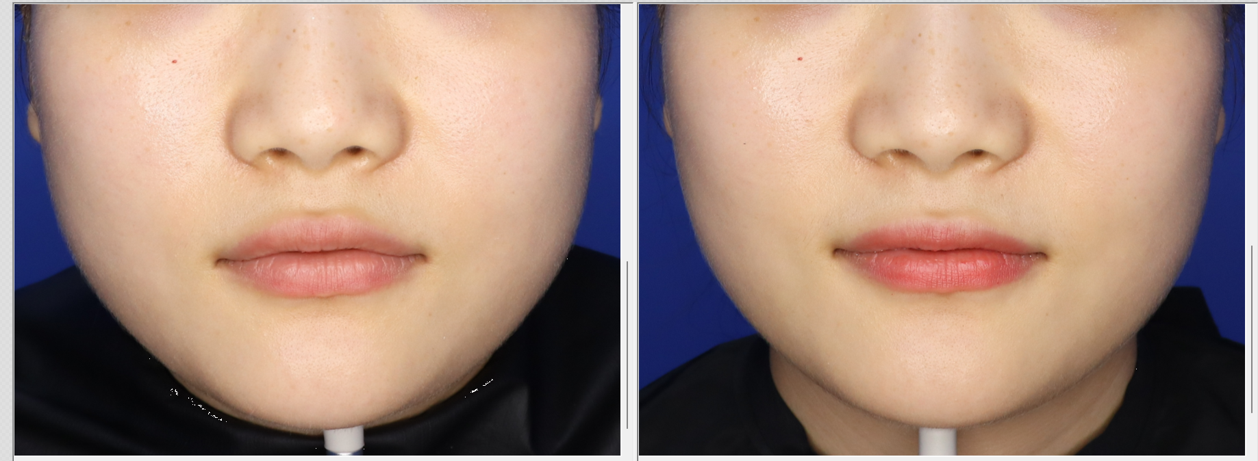 안면윤곽톡신 리얼 후기